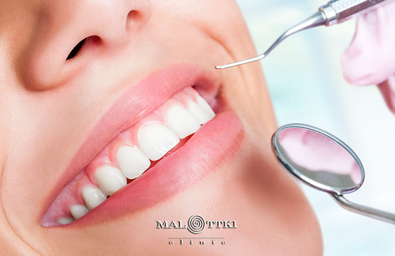 usuwanie kamienia nazębnego opole