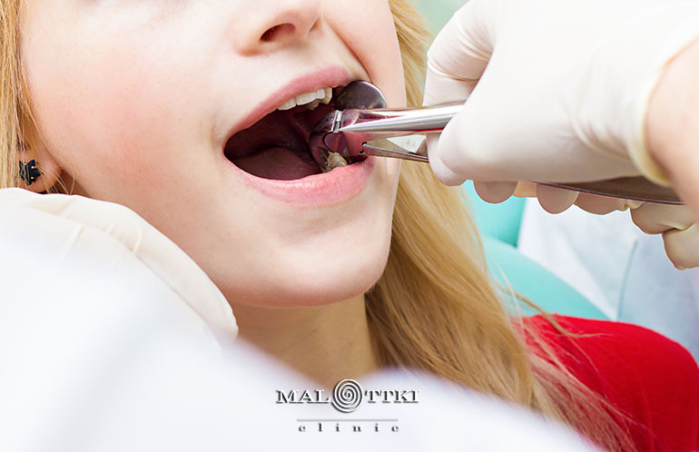 ekstrakcja zębów opole