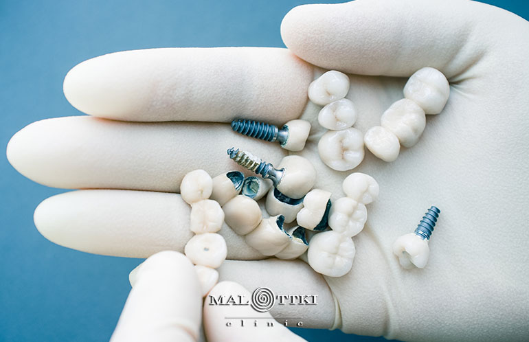 implanty w jeden dzień opole