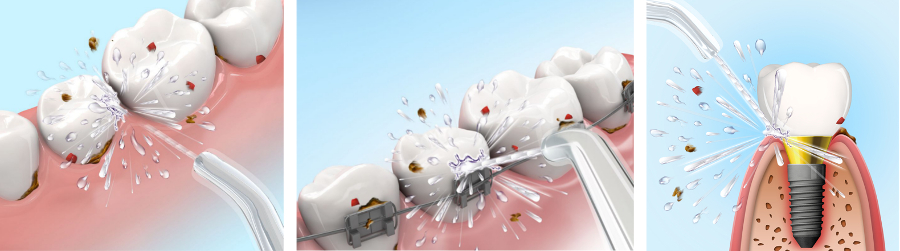 irygator do mycia zębów