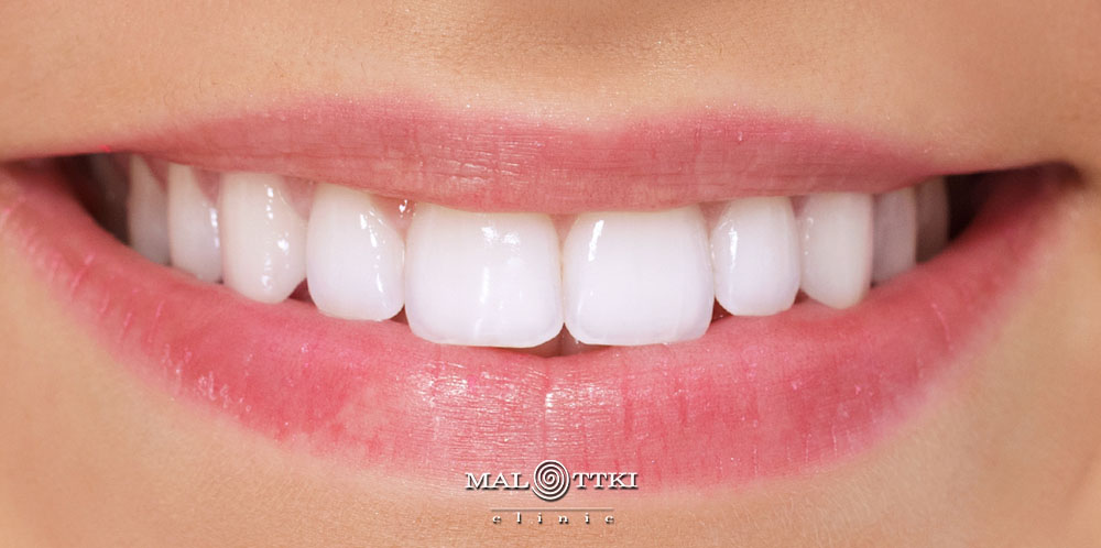 wybielanie zębów opole