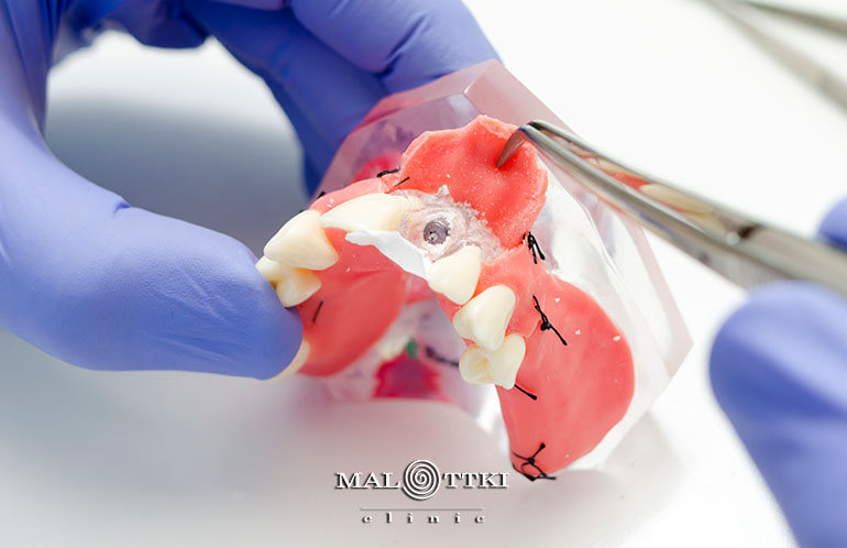 odbudowa zębów opole