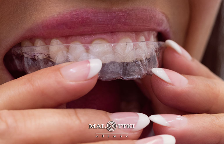 niewidoczny aparat invisalign opole