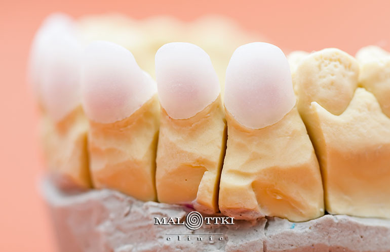 rodzaje koron protetycznych malottki