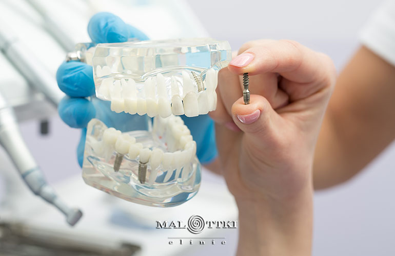 wszystko co warto wiedzieć o implantach opole