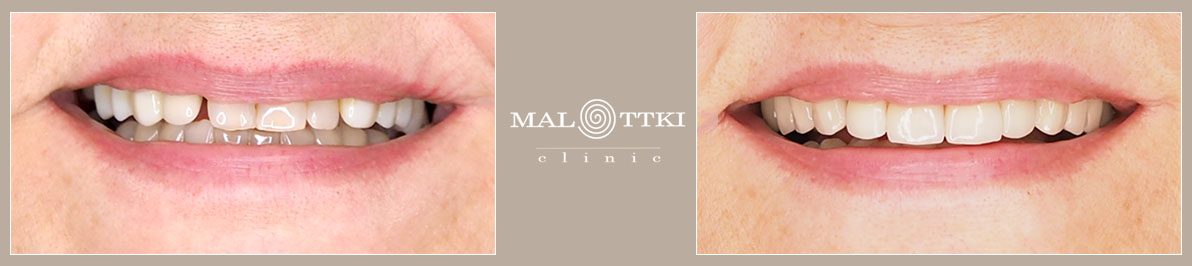 korony porcelanowe odbudowa zębów