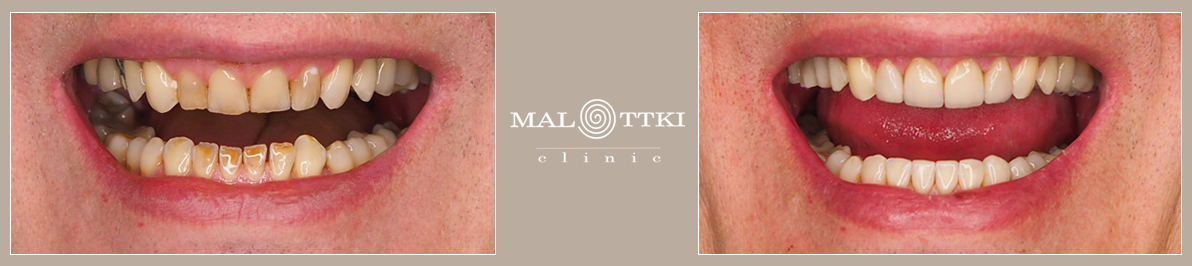 licówki porcelanowe