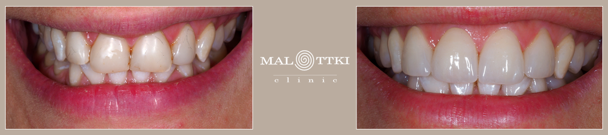 wybielanie zębów prevdent