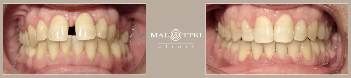 leczenie ortodontyczne opole