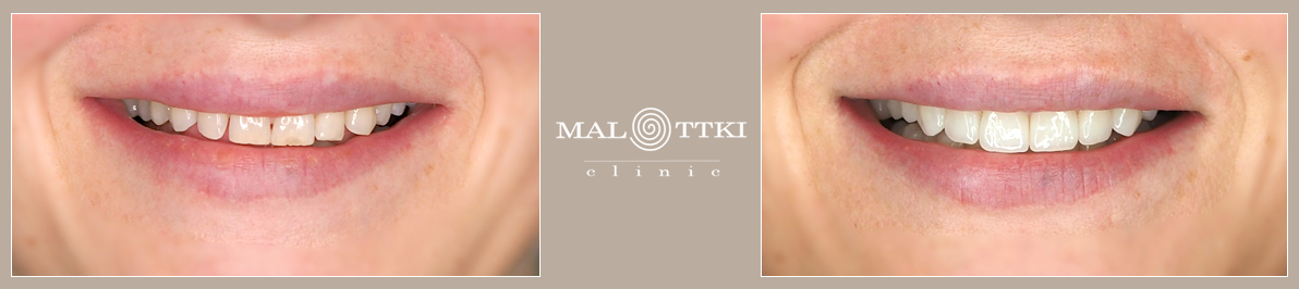 porcelanowe licówki opole