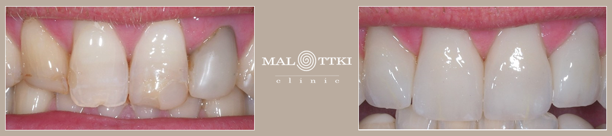 licówki zębowe ręcznie napalane