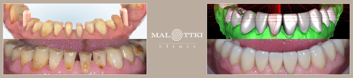 odbudowa startych zębów