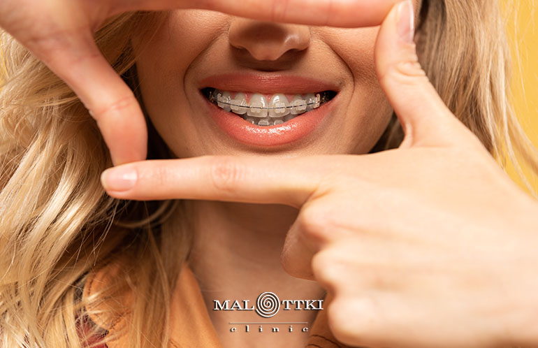 aparat ortodontyczny opole