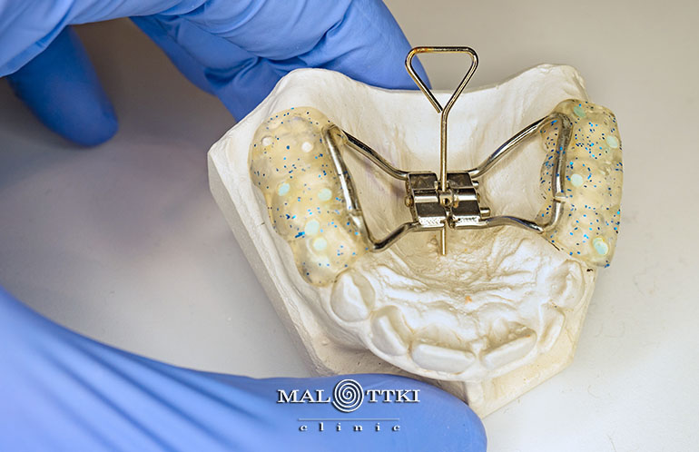 aparat na zęby ze śrubą hyrax opole