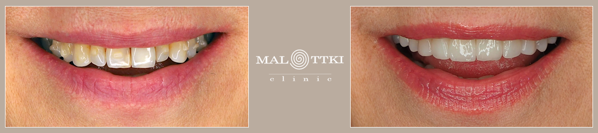 leczenie zębów nakładkami invisalign