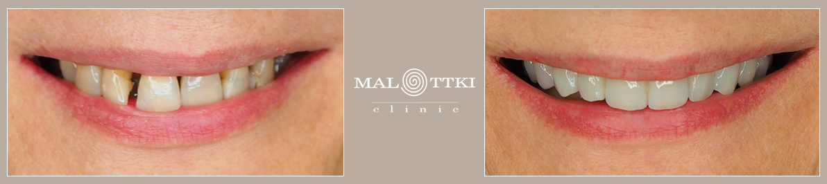 odbudowa górnego łuku koronami pełnoceramicznymi i implantami