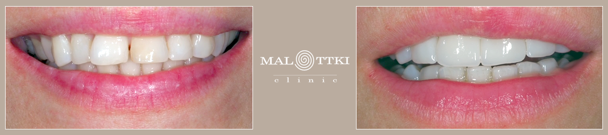 porcelanowe licówki wybielanie zębów