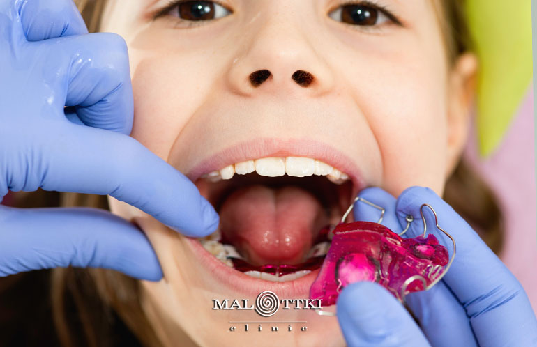 płytka retencyjna hawleya opole