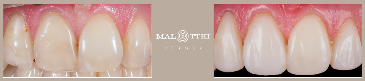 gabinetowe wybielanie zębów