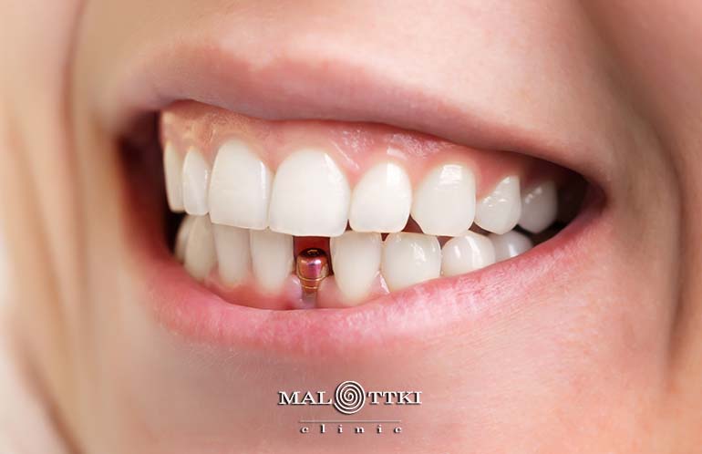 ciekawostki o implantach zębowych opole