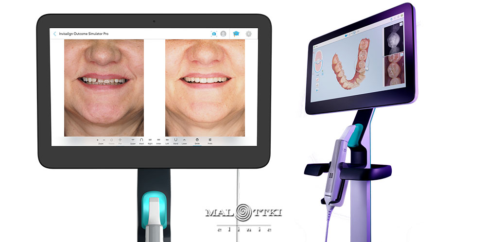 skaner wewnątrzustny