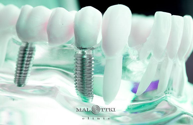 kiedy konieczna jest odbudowa kości pod implant opole