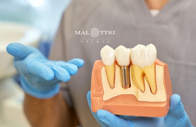 implanty do końca życia opole