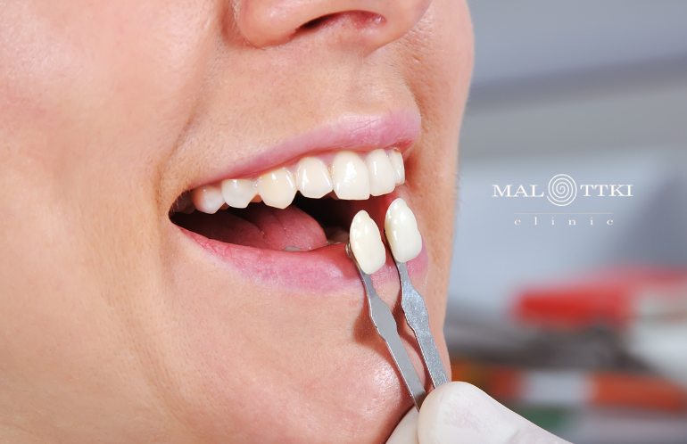 protetyka stomatologiczna Malottki opole